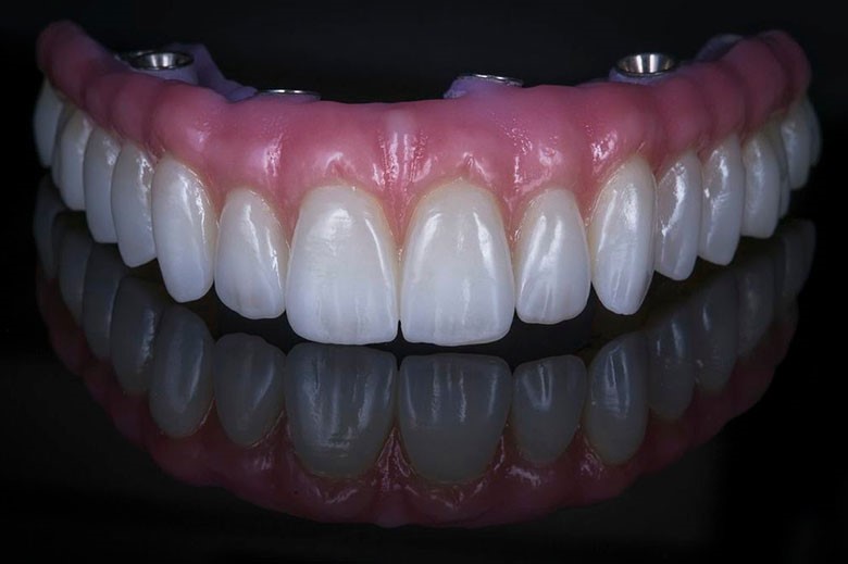 Upper Dentures Before And After Pictures Cincinnati OH 45224